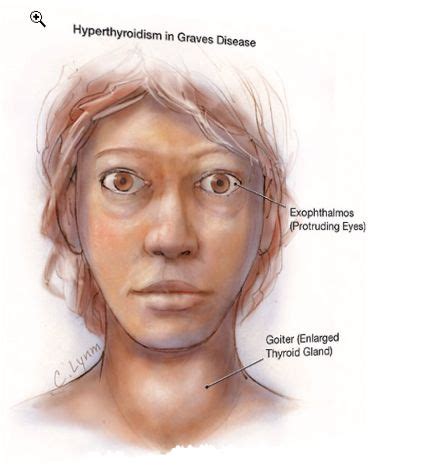 Exophthalmus or “bulging eyes” in Hyperthyroidism | What an EYESORE! | Pinterest | Thyroid and ...