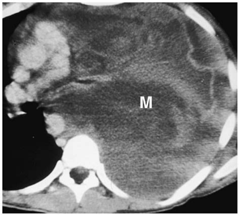 Mediastinum | Radiology Key