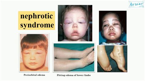 nephrotic syndrome - YouTube