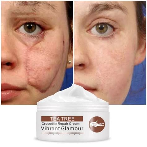 Scar Repair Face Cream Acne Removal Whitening Acne Treatment Stretch Marks Skin Care Cream-in ...