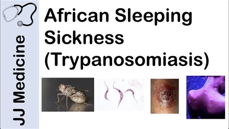 Trypanosoma Brucei Symptoms