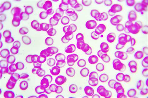 Iptacopan Shows Promise in First Line Treatment of Paroxysmal Nocturnal Hemoglobinuria ...