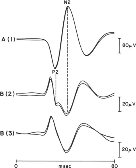 Cortical somatosensory evoked potentials in response to hand stimulation in: Journal of ...