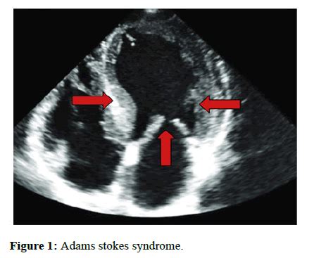 Gerbec Morgagni Adams Stokes Syndrome