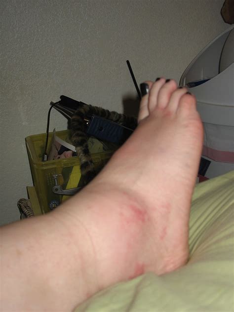 Swollen feet after an allergic reaction to fire ant bites | Flickr - Photo Sharing!