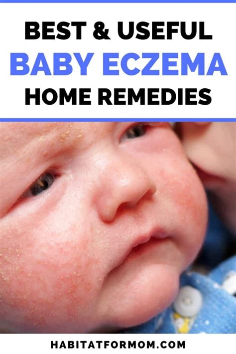 Best Remedies for Baby Eczema (ultimate list) | Habitat For Mom