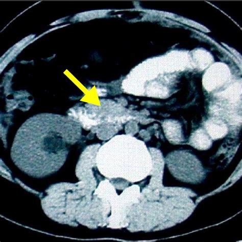 Contrast enhanced computerized tomography of the abdomen, showing a... | Download Scientific Diagram