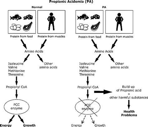 Propionic acidemia causes, symptoms, diagnosis, treatment & prognosis