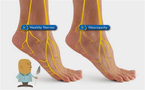 Low Blood Sugar Symptoms: Diabetic Nerve Pain Medicine