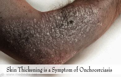 Onchocerciasis | River Blindness - Causes, Symptoms, Diagnosis, Treatment, Prevention