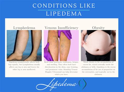 » Everything You Need To Know About Lipedema, from 1 Lippy Lady to Another - Lipedema