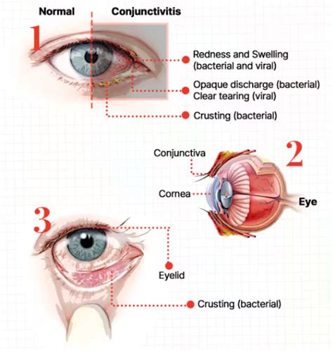 Conjunctivitis Causes Symptoms and Treatment Options. - Best Hospital ...