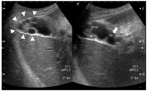 Diagnostics | Free Full-Text | A Case of Early-Stage Gallbladder Cancer ...