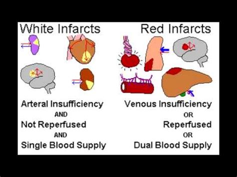 Infarcts: Red vs Pale - YouTube