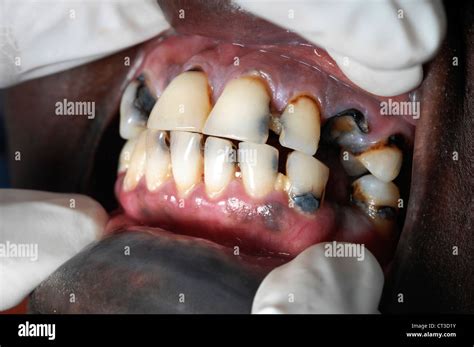 Decaying teeth Stock Photo - Alamy