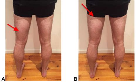 Hamstring Injury - Causes, Symptoms, Recovery Time & Treatment