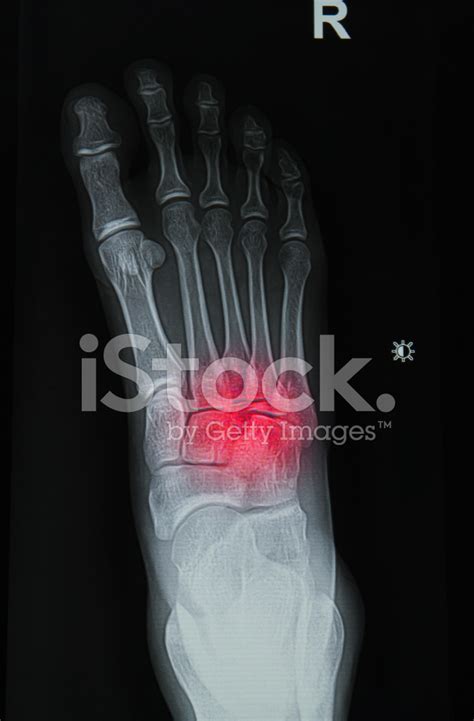 X-Rays Image Of The Painful Or Injury Foot Stock Photo | Royalty-Free | FreeImages