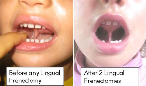 Frenectomy - Debug Your Health