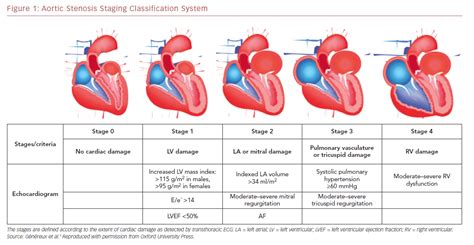 Aortic Valve Stenosis Vs Regurgitation - Lalocades