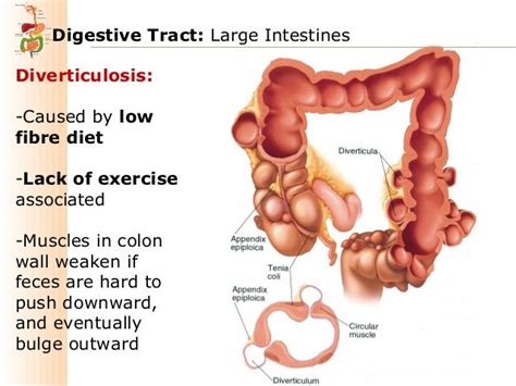 Treating Diverticulitis