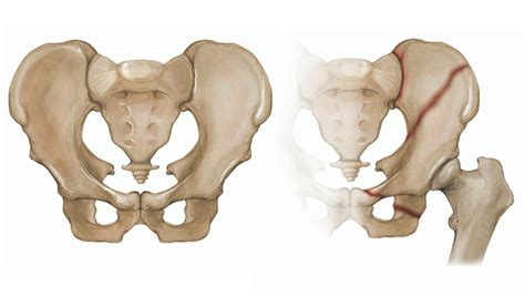 Pelvic Fractures - Hughston Clinic