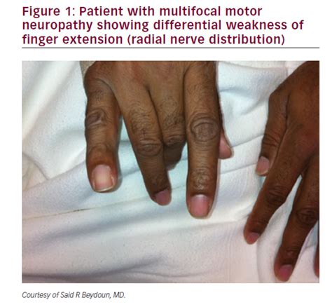 Differentiating Multifocal Motor Neuropathy from Entrapment Neuropathy – A Diagnostic Challenge ...