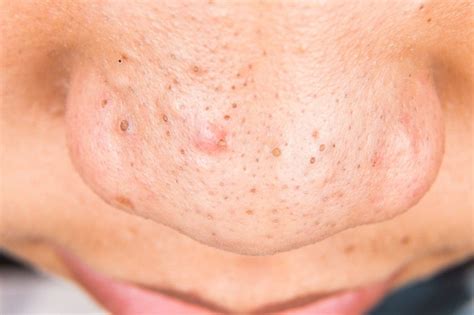 How to Get Rid of Blackheads Fast with This Simple Home Remedy