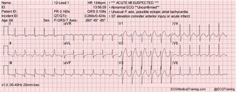 Usefulness of the QRS/T angle when diagnosing acute STEMI - ECG Medical ...