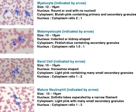 Morphological features of myelocytes, metamyelocytes, band cells and ...