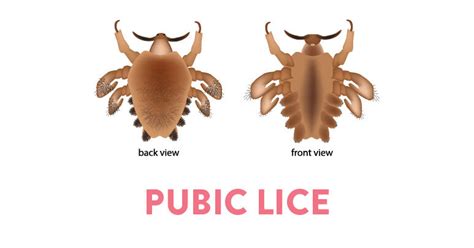 Pubic Lice Infestation | CK Birla