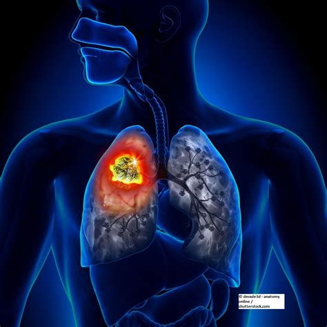 Nab-Paclitaxel an Option for Second-Line Advanced NSCLC? | Cancer Network