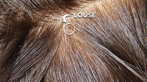 How to Tell If You Have Lice | Lice Clinics of America