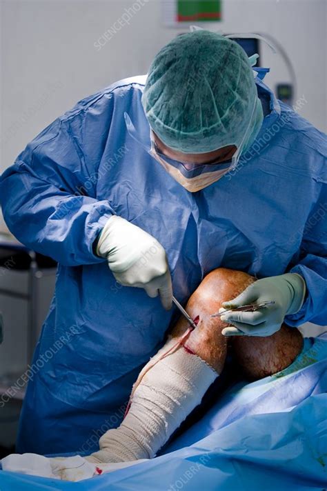 Knee ligament repair surgery - Stock Image - C008/5207 - Science Photo Library