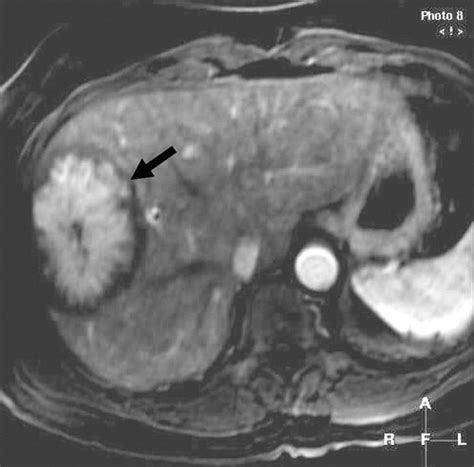 Focal Nodular Hyperplasia Gross