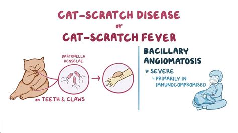 Bartonella henselae (Cat-scratch disease and Bacillary angiomatosis) | Osmosis