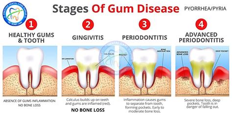 Periodontitis & Gingivitis Meaning Symptoms Tx | Gum Disease