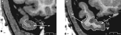 Structure of collateral sulcus | Semantic Scholar