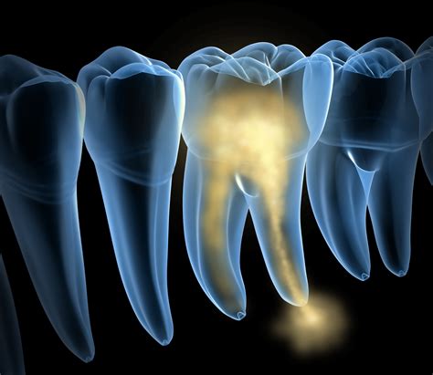 Common Signs of Tooth Nerve Damage - Sunrise Oral Surgery