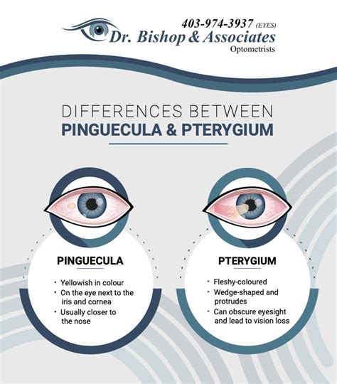 Pinguecula vs. Pterygium: What’s the Difference? | Calgary