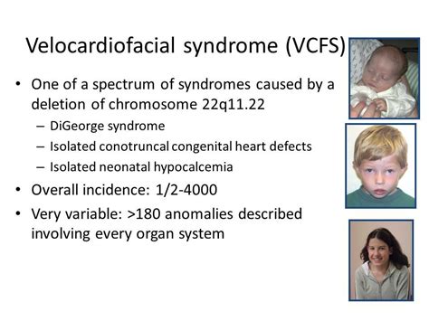 Pin by nonas arc on DiGeorge Syndrome | Digeorge syndrome, Congenital ...