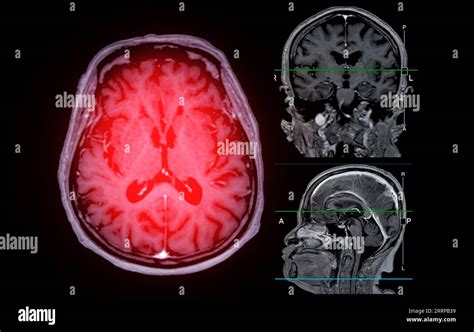 MRI brain scan Axial , Coronal and sagittal view with referance line ...