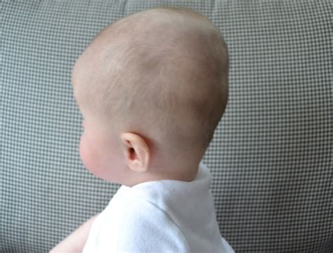 Brachycephaly: Symptoms, Causes and Treatment - Scope Heal