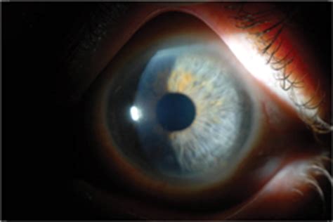 Wills Eye Resident Case Series - Diagnosis & Discussion