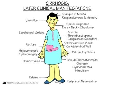 Cirrhosis in the liver life expectancy. http://www.hepaticsteatosis.net/cirrhosis-of-the-liver ...