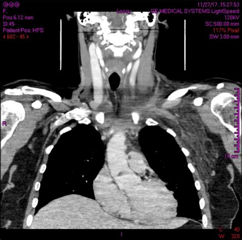 Primary, exercise induced internal jugular vein thrombosis – a case report