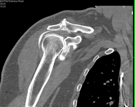 Shoulder Bursitis Rotator Cuff Tear Mri