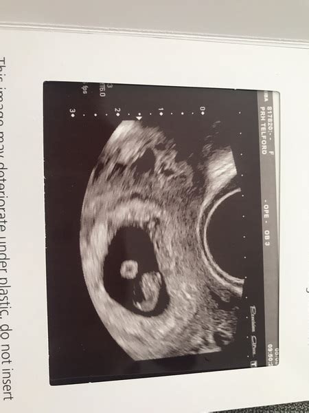 8 Week Ultrasound Hidden Twins