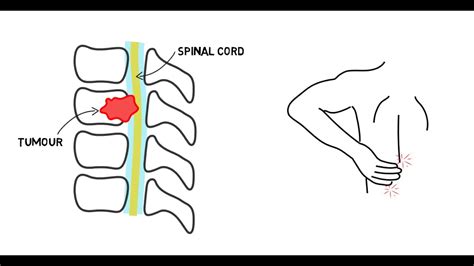 Spinal Cord Compression - YouTube