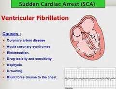 20 best Ventricular Fibrillation images on Pinterest | Nursing schools ...