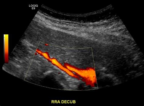 Renal Artery Duplex Ultrasound - Angiologist